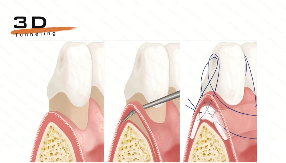 3D Tunnelling illustration showing the periodontal tissues, instrument access, and suturing