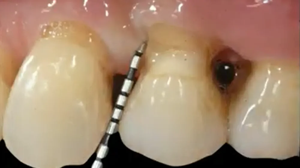 Periodontal probing shown in the first lesson