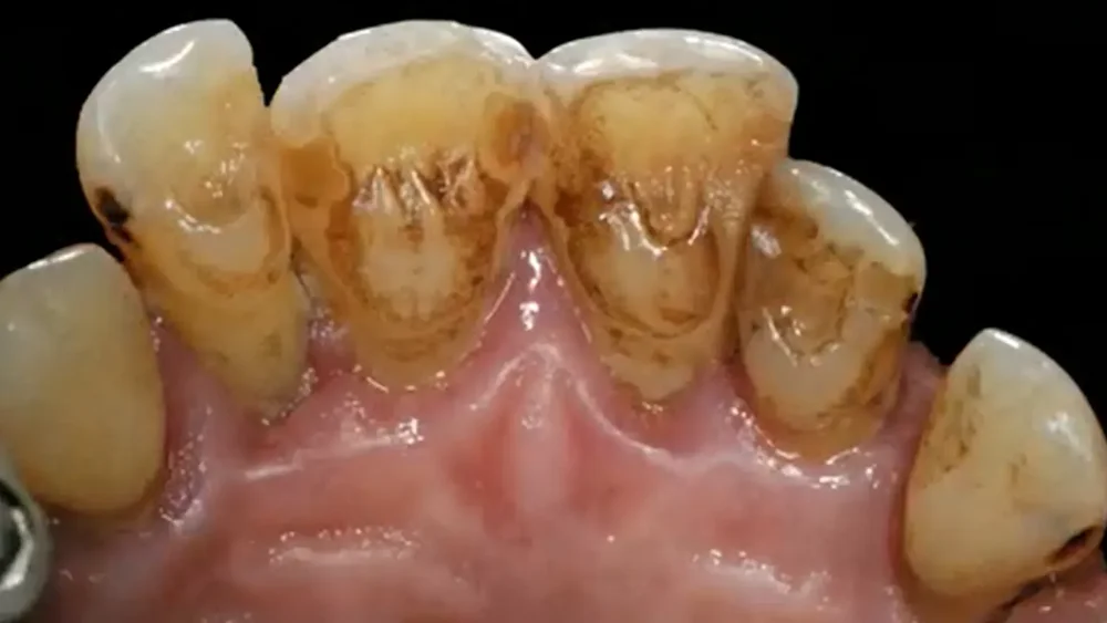Clinical still from the lesson: The challenge of the interproximal attachment gain