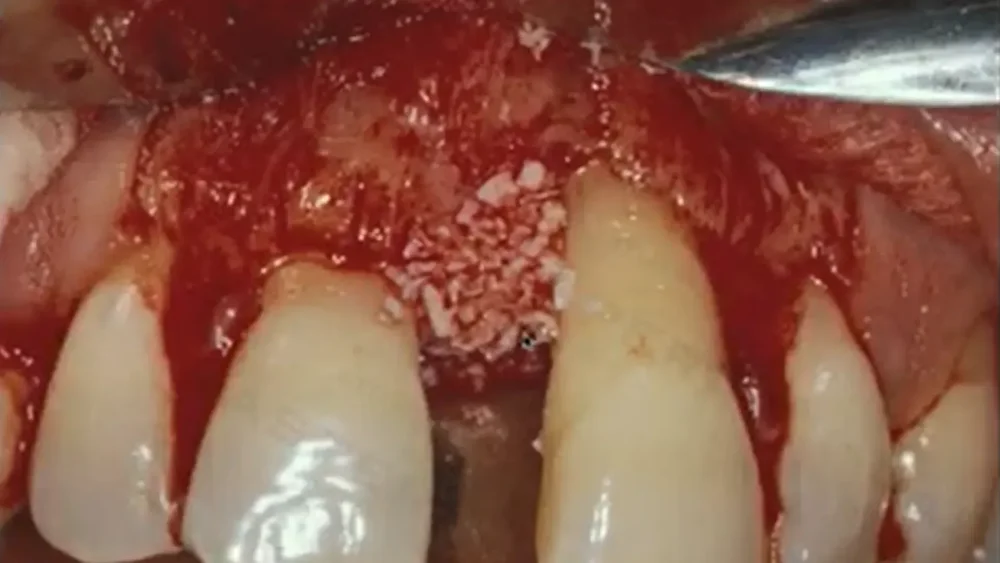 Clinical view of regenerative material placement from lesson three