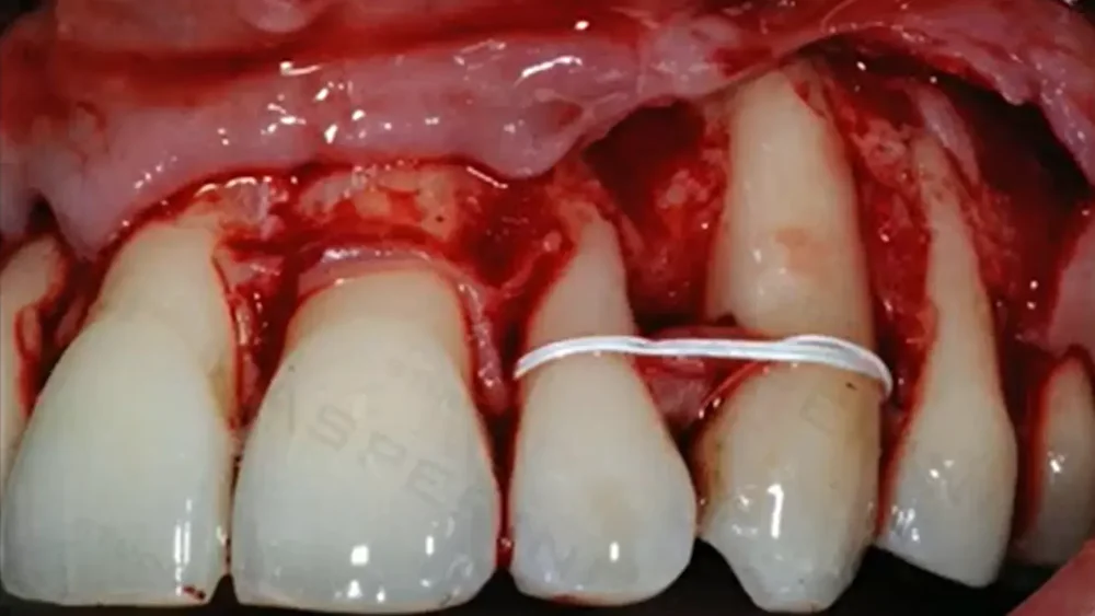 Clinical still from the lesson: Papilla loss and intrabony defect treatment possibilities