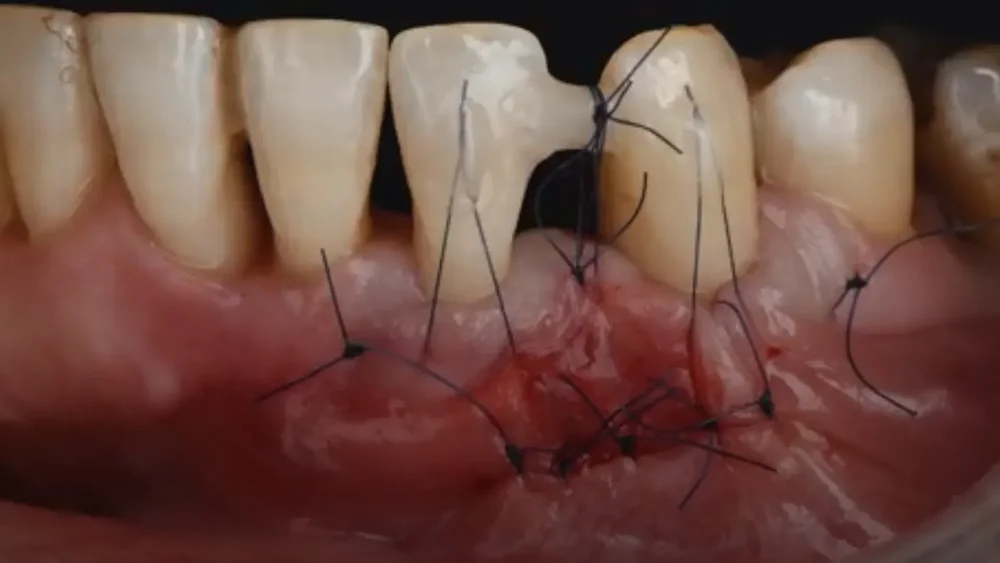 Clinical still from the lesson: Periodontitis: the sixth most common disease in humanity