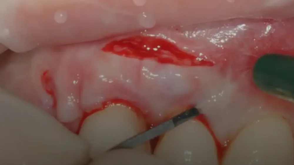 Clinical still from the lesson: Gingival papilla reconstruction