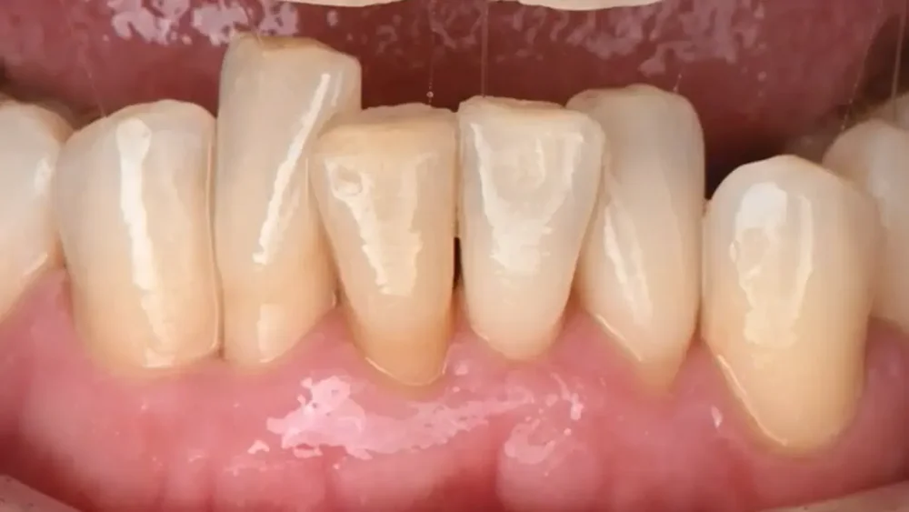 Clinical still from the lesson: Advancing Periodontology: Regenerative Techniques for Gingival and Papilla Reconstruction