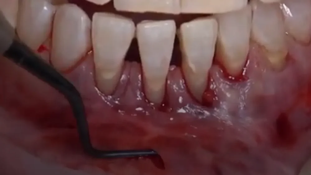 Clinical still from the 3D Tunnelling ReLIVE Surgery